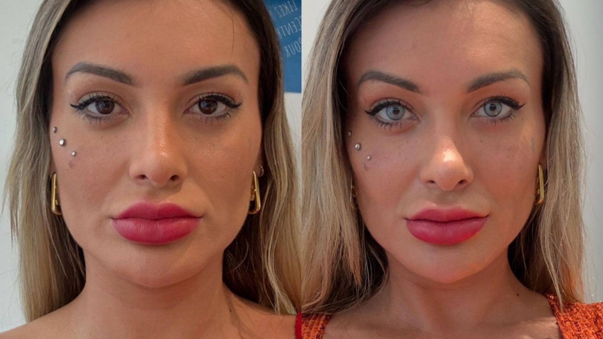 Ceratopigmentação: entenda riscos de cirurgia para mudar cor dos olhos Ceratopigmentação: entenda riscos de cirurgia para mudar cor dos olhos