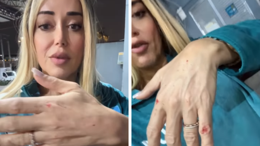 Mulher Abacaxi sofre tentativa de assalto em SP e mostra escoriações na mão Mulher Abacaxi sofre tentativa de assalto em SP e mostra escoriações na mão