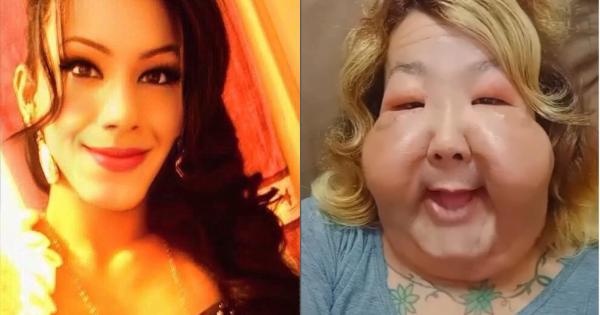 Quem é Juju do Pix; influencer que teve rosto deformado por óleo mineral Quem é Juju do Pix; influencer que teve rosto deformado por óleo mineral