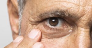 Glaucoma pode evoluir sem sintomas e comprometer a visão permanentemente